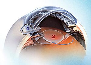 低溫等離子表面處理人工晶體狀