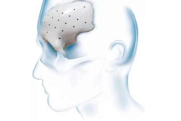 等離子清洗機(jī)會(huì)對(duì)PEEK材料起到怎樣的作用？-普樂(lè)斯