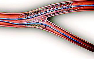 【普樂斯】等離子表面處理設(shè)備處理血管支架